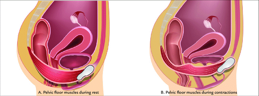 Pelvic floor muscle training for overactive bladder symptoms