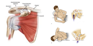 Internal image of AC joint tear