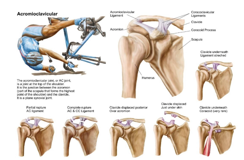 Acromioclavicular joint injury - YOUtherapies